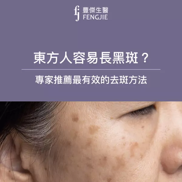 為何東方人容易長黑斑?專家推薦5大消除黑斑方法,愛美必看!