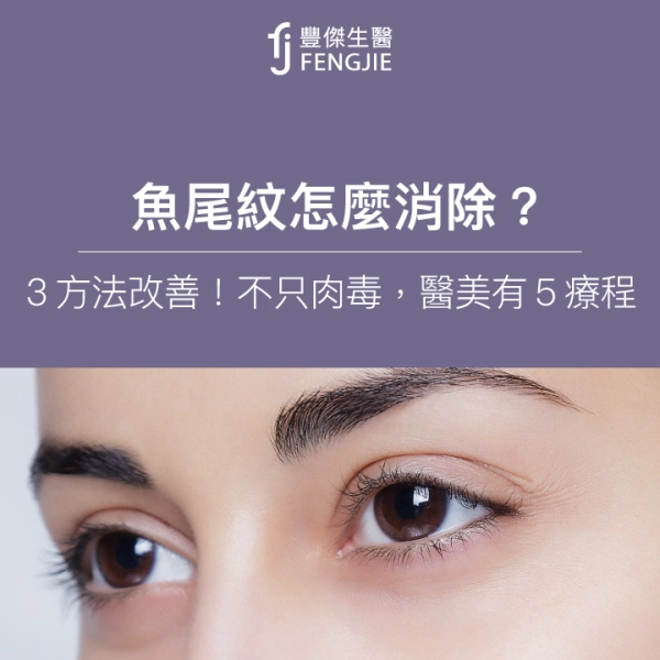 魚尾紋怎麼消除?專家3方法改善!不只肉毒,醫美有5大療程