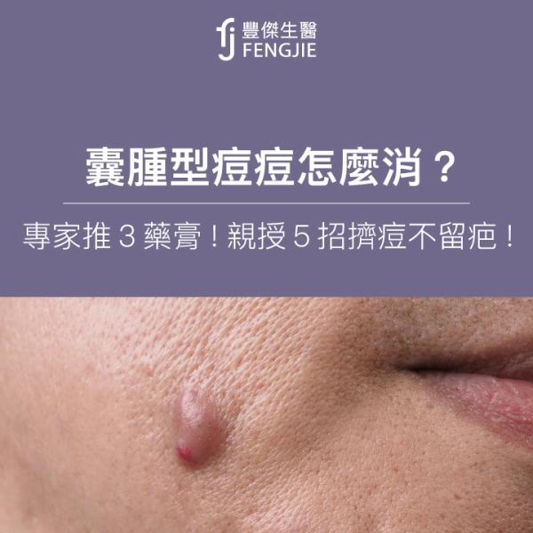 囊腫型痘痘怎麼消?專家推3藥膏!親授5招擠痘不留疤!