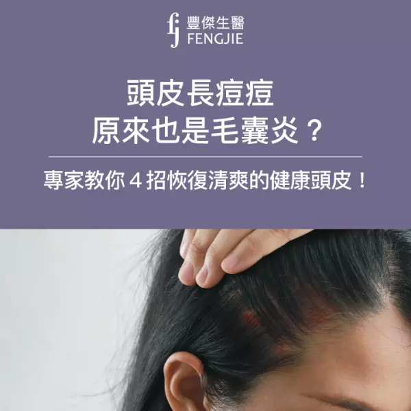 頭皮長痘痘原來也是毛囊炎?專家教你4招恢復清爽的健康頭皮!