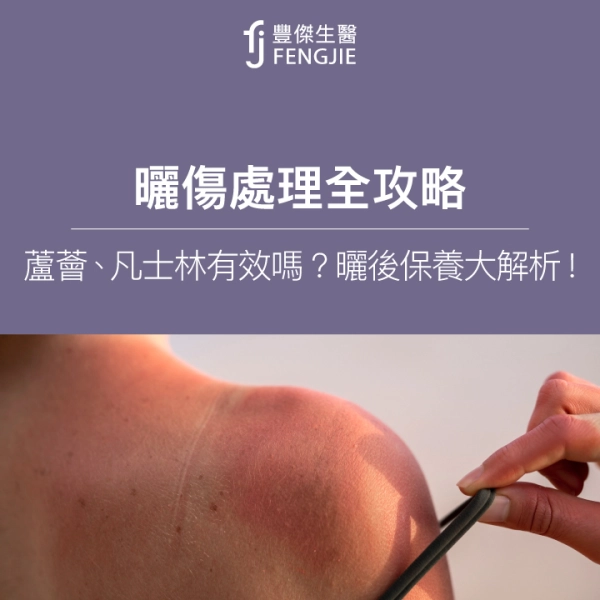 曬傷可以塗凡士林嗎？  高效曬傷護理攻略及完整教學