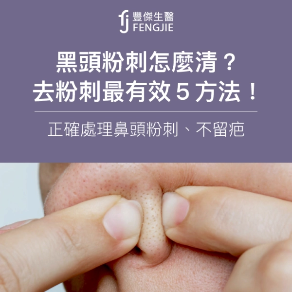 黑頭粉刺怎麼清?去粉刺最有效5方法!正確處理鼻頭粉刺、不留疤
