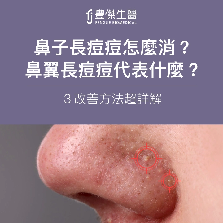 鼻子長痘痘怎麼消?鼻翼長痘痘代表什麼?3改善方法超祥解