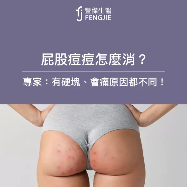 屁股痘痘怎麼消?專家:有硬塊、會痛原因不同!該看什麼科?