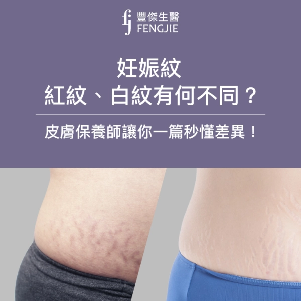 妊娠紋紅紋、白紋有何不同?懷孕「前中後期」變化過程詳解!