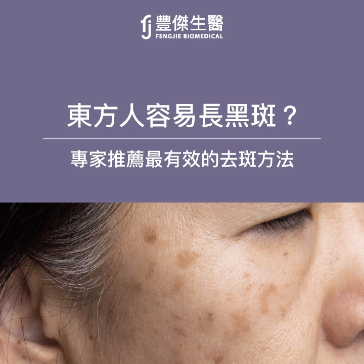 為何東方人容易長黑斑？專家推薦5大消除黑斑方法，愛美必看！