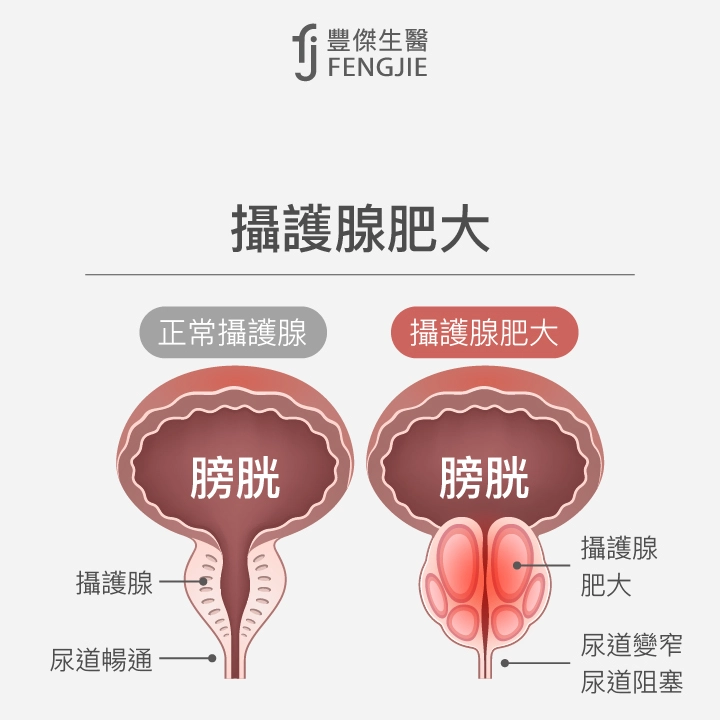 攝護腺肥大