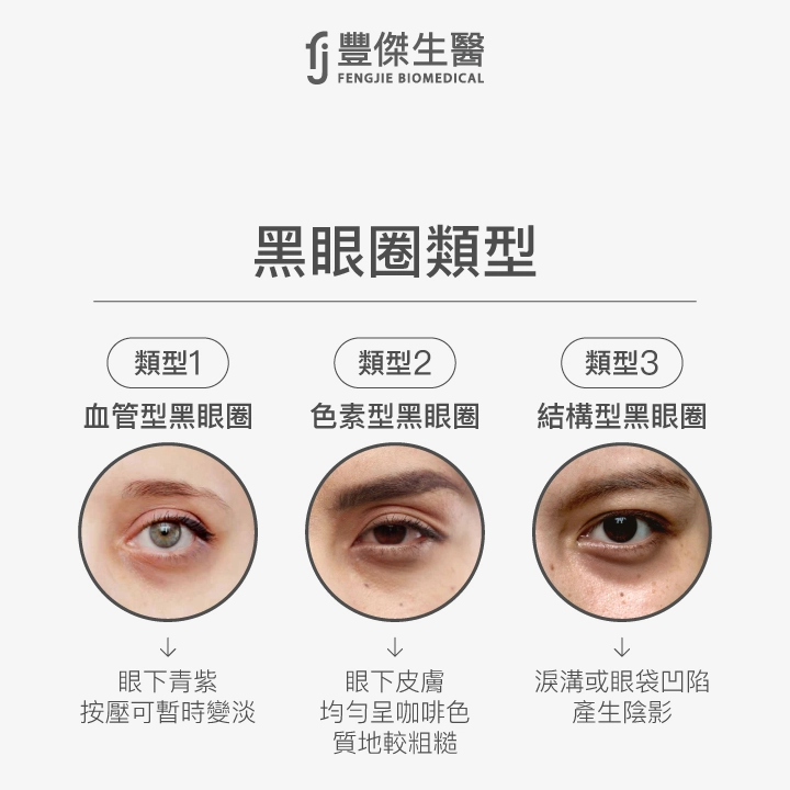 黑眼圈類型:血管型黑眼圈、色素型黑眼圈、結構型黑眼圈