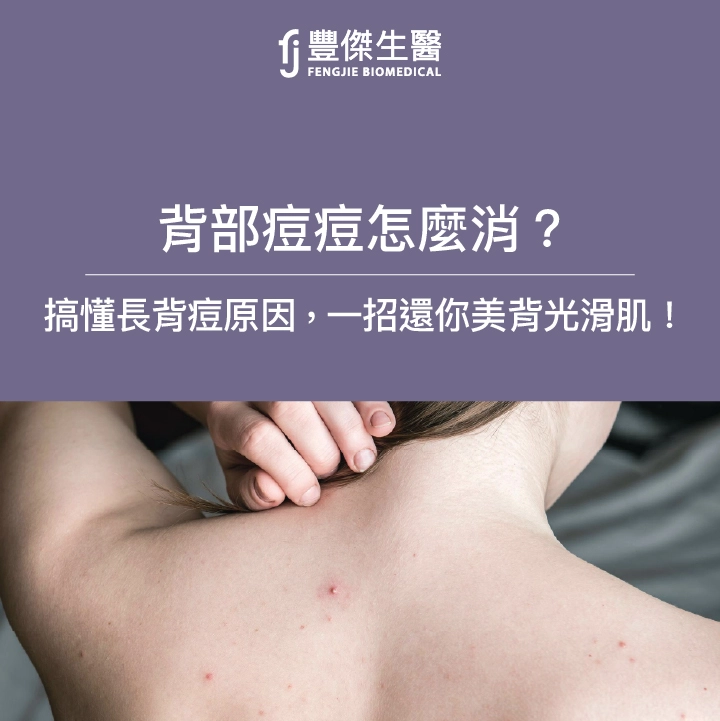 背部痘痘怎麼消?先搞懂長背痘原因,一招還你美背光滑肌!