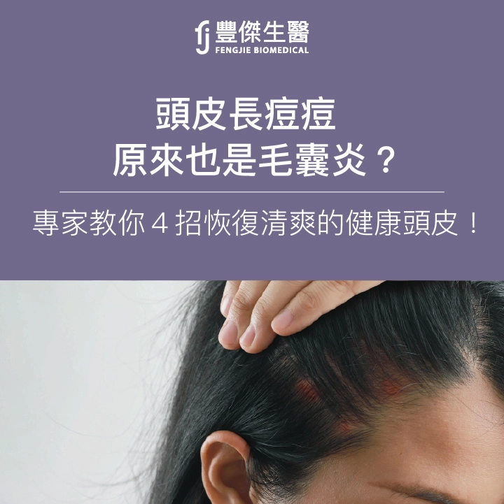 頭皮長痘痘原來也是毛囊炎？專家教你4招恢復清爽的健康頭皮！