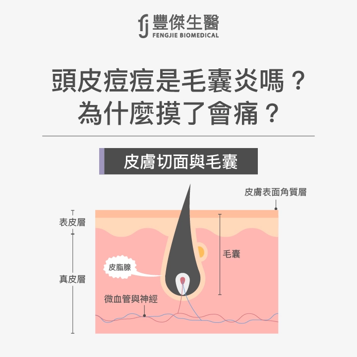 頭皮痘痘是毛囊炎嗎？為什麼摸了會痛？