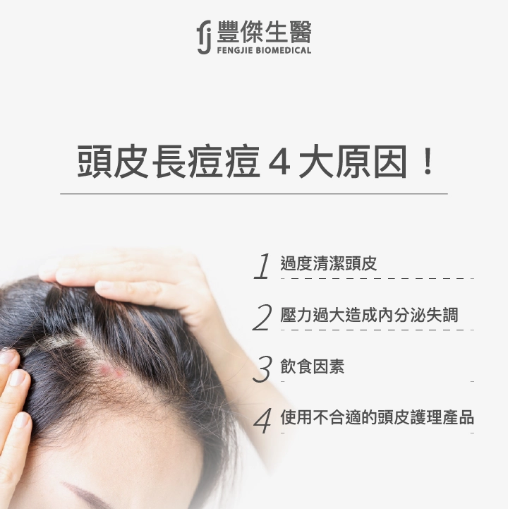 頭皮長痘痘4大原因！