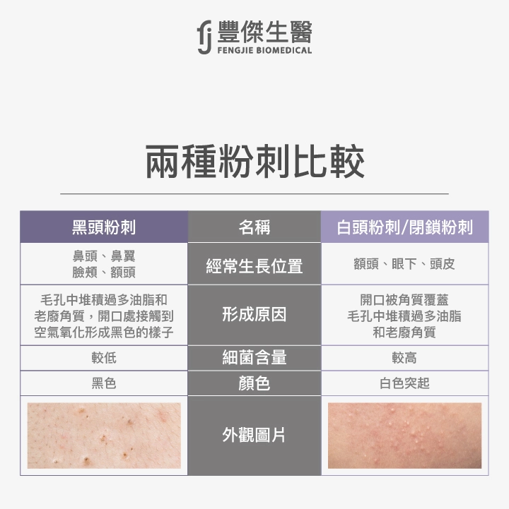 兩種粉刺比較