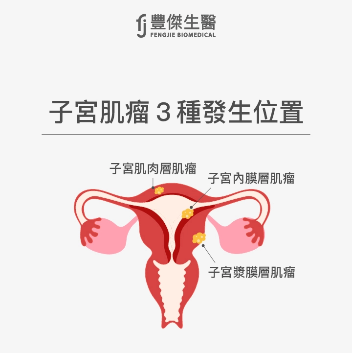 子宮肌瘤3種發生位置:子宮肌肉層肌瘤、子宮漿膜層肌瘤、子宮內膜層肌瘤