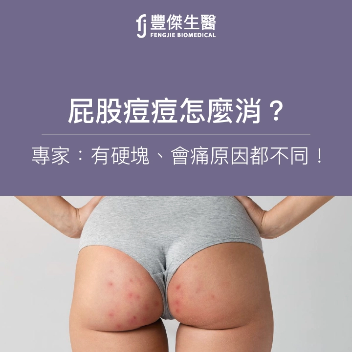 屁股痘痘怎麼消？專家：有硬塊、會痛原因不同！該看什麼科？