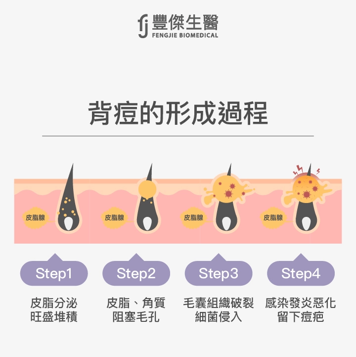 背痘怎麼形成的