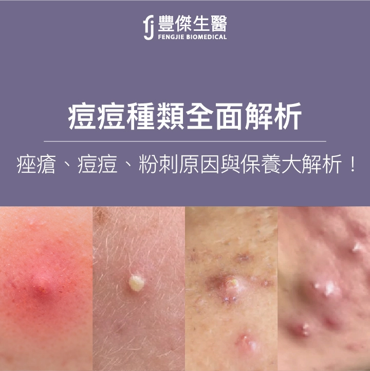 痘痘種類全面攻略：痤瘡、痘痘、粉刺原因與保養大解析！