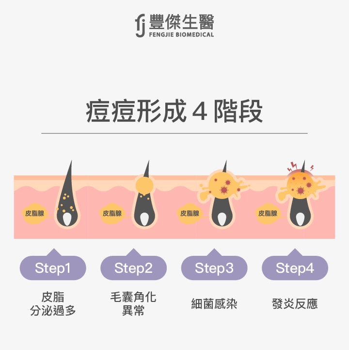 痘痘形成4階段：皮脂分泌過多、毛囊角化異常、 細菌感染、 發炎反應