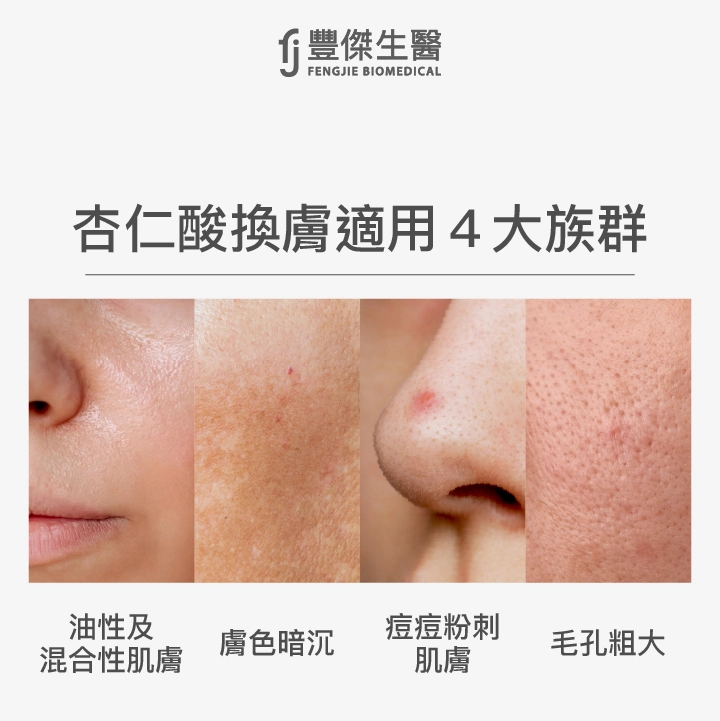 杏仁酸換膚適用4大族群：油性及混合性肌膚、膚色暗沉、痘痘粉刺肌膚、毛孔粗大