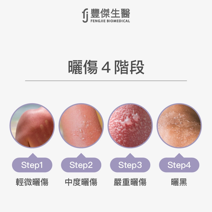 曬傷4階段：輕微曬傷、中度曬傷、嚴重曬傷、曬黑