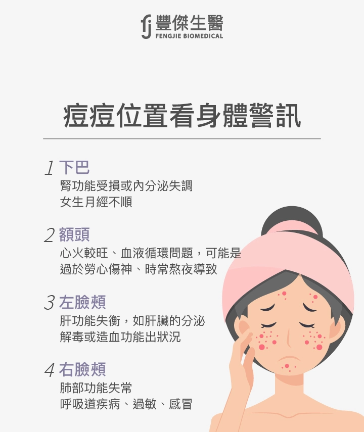 痘痘位置看身體警訊：下巴、額頭、左臉頰、右臉頰