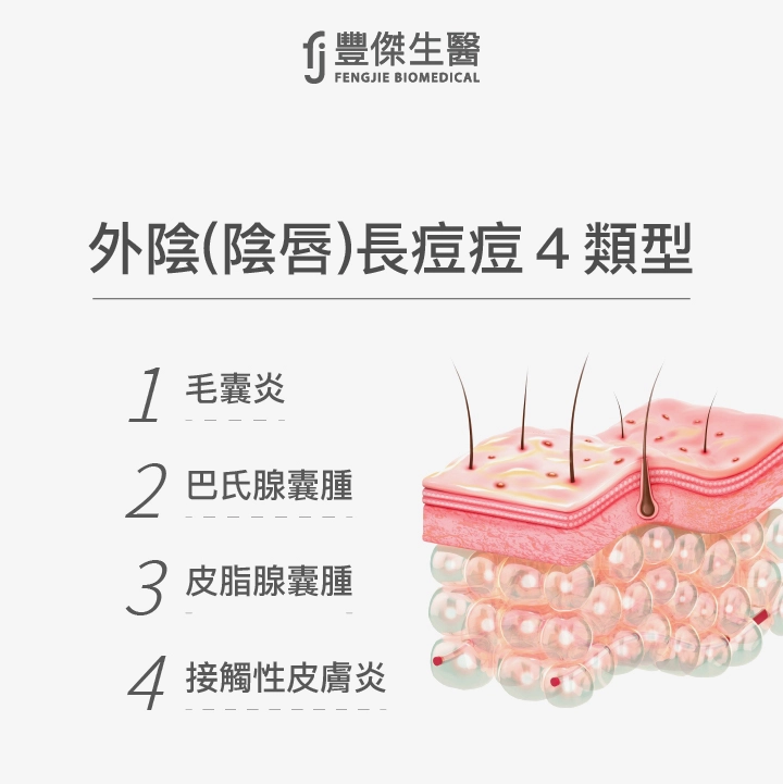 外陰（陰唇）長痘痘4類型：毛囊炎、巴氏腺囊腫、皮脂腺囊腫、接觸性皮膚炎