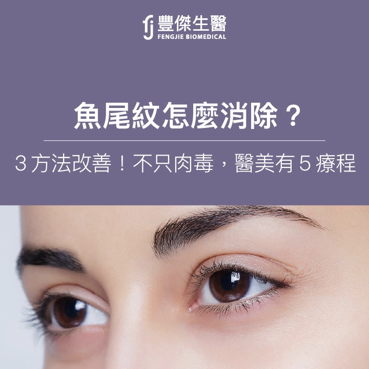 魚尾紋怎麼消除？專家3方法改善！不只肉毒，醫美有5大療程