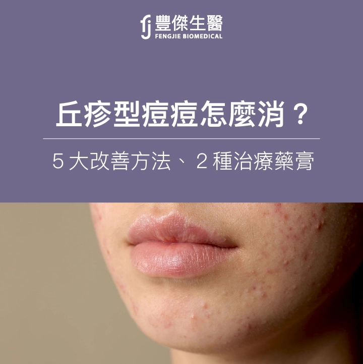 丘疹型痘痘怎麼消？專家揭改善5大方法！這2種藥膏可治療