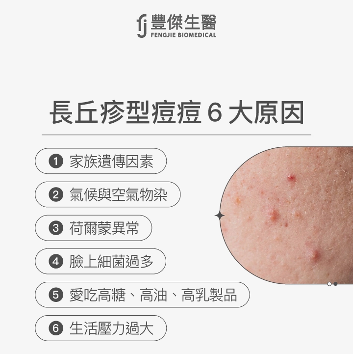 長丘疹型痘痘6大原因：家族遺傳因素、氣候與空氣物染、荷爾蒙異常、臉上細菌過多、愛吃高糖、高油、高乳製品、生活壓力過大