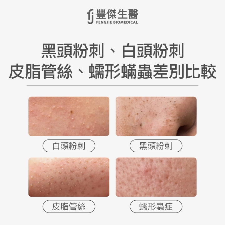 黑頭粉刺、白頭粉刺、皮脂管絲、蠕形蟎蟲差別比較