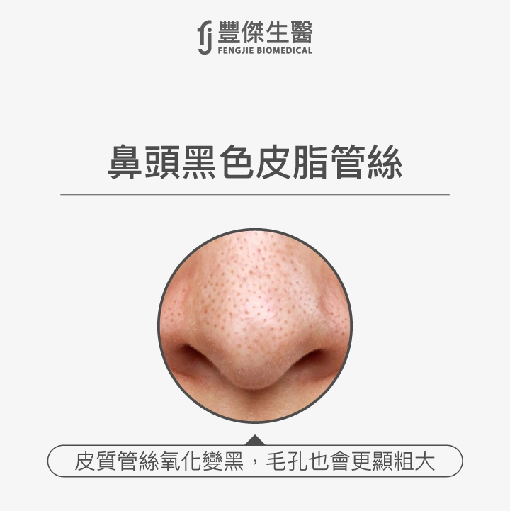 鼻頭黑色皮脂管絲