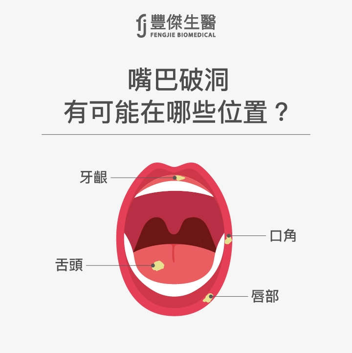 嘴巴破洞白色部位是什麼？代表身體什麼狀況？