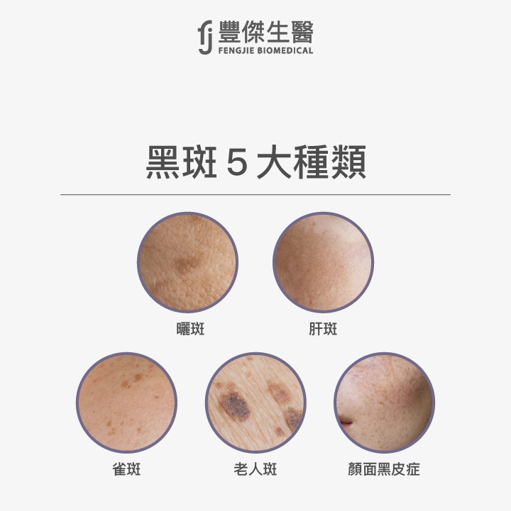 黑斑5大種類：曬斑、肝斑、雀斑、老人斑、顏面黑皮症