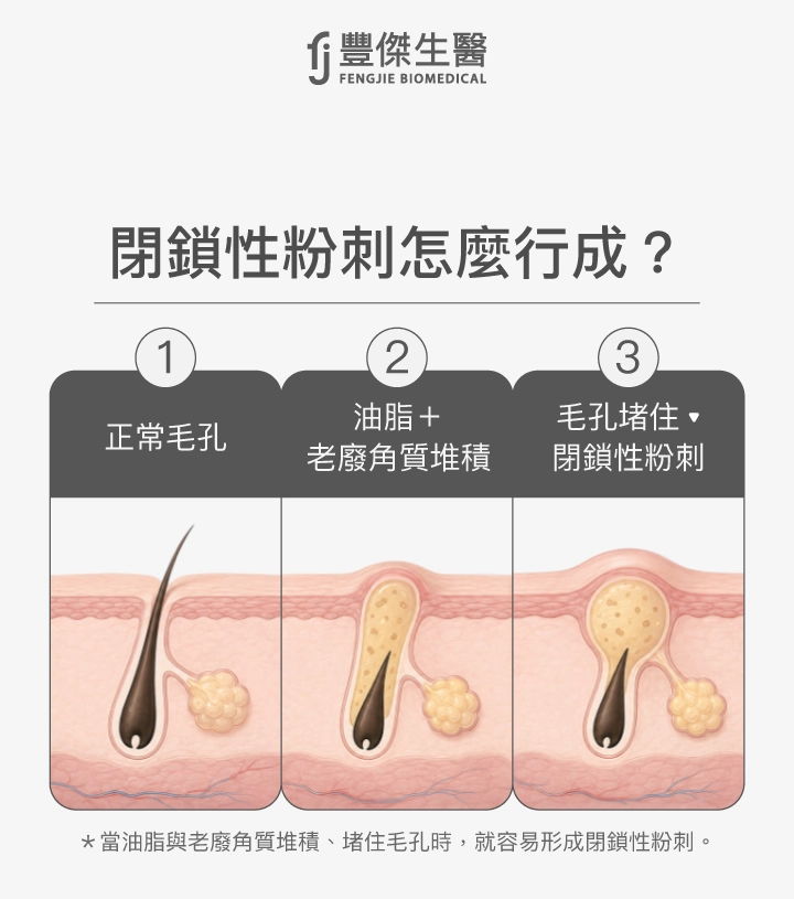 閉鎖性粉刺怎麼保養？