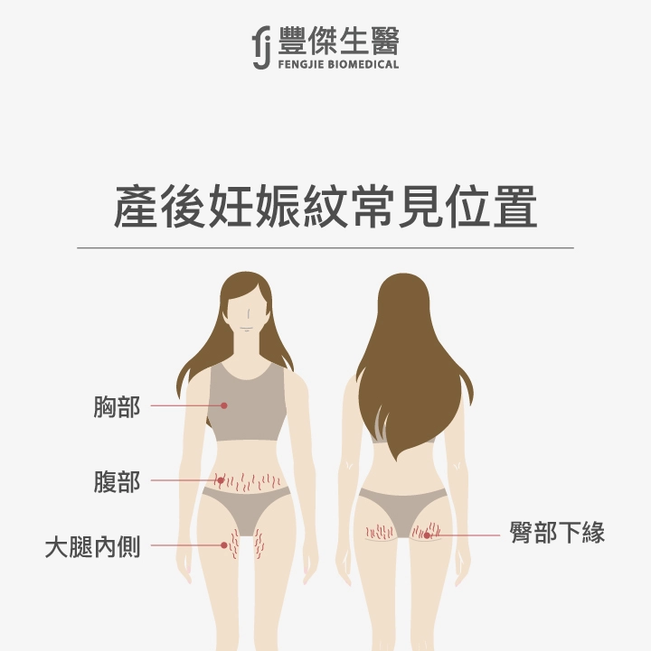 產後妊娠紋常見位置:腹部、胸部、臀部下緣、大腿內側