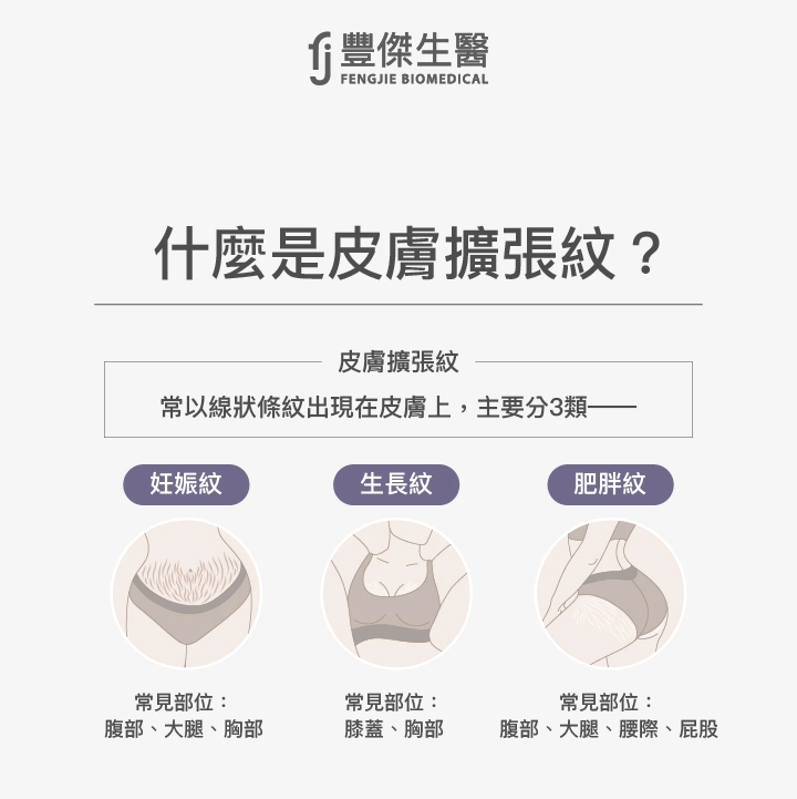 皮膚擴張紋3種類:妊娠紋、生長紋、肥胖紋