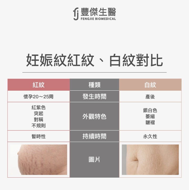 妊娠紋紅紋、白紋對比