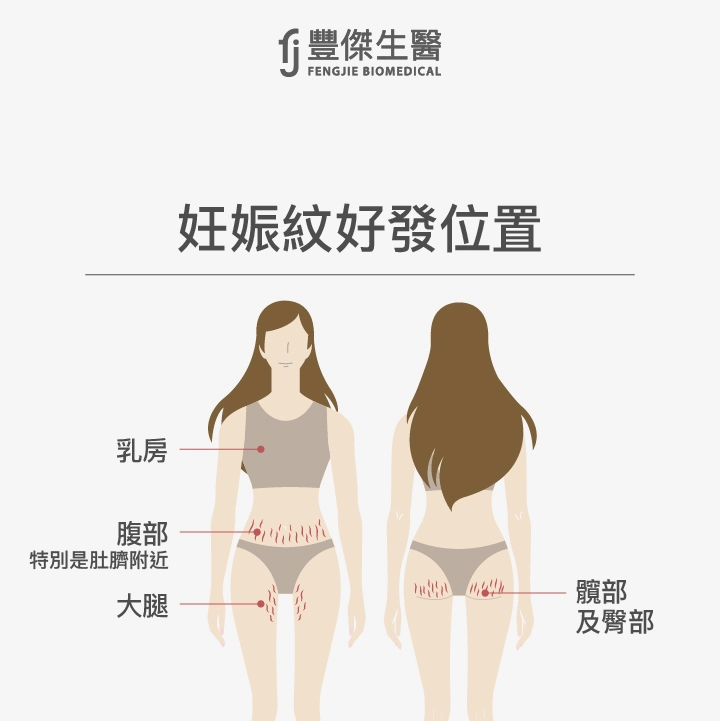 妊娠紋好發位置