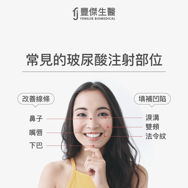 常見的玻尿酸注射部位