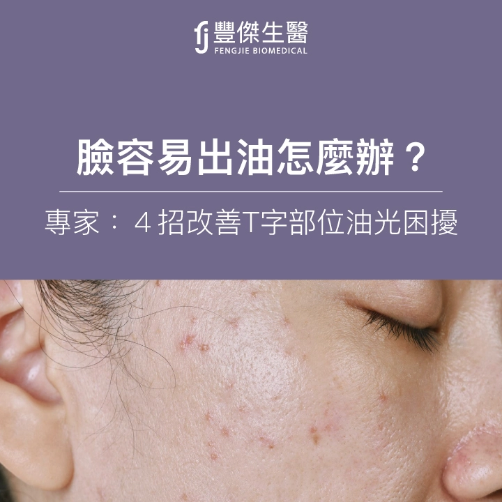 臉容易出油怎麼辦？專家推4招改善T字油光、3大清爽控油成分